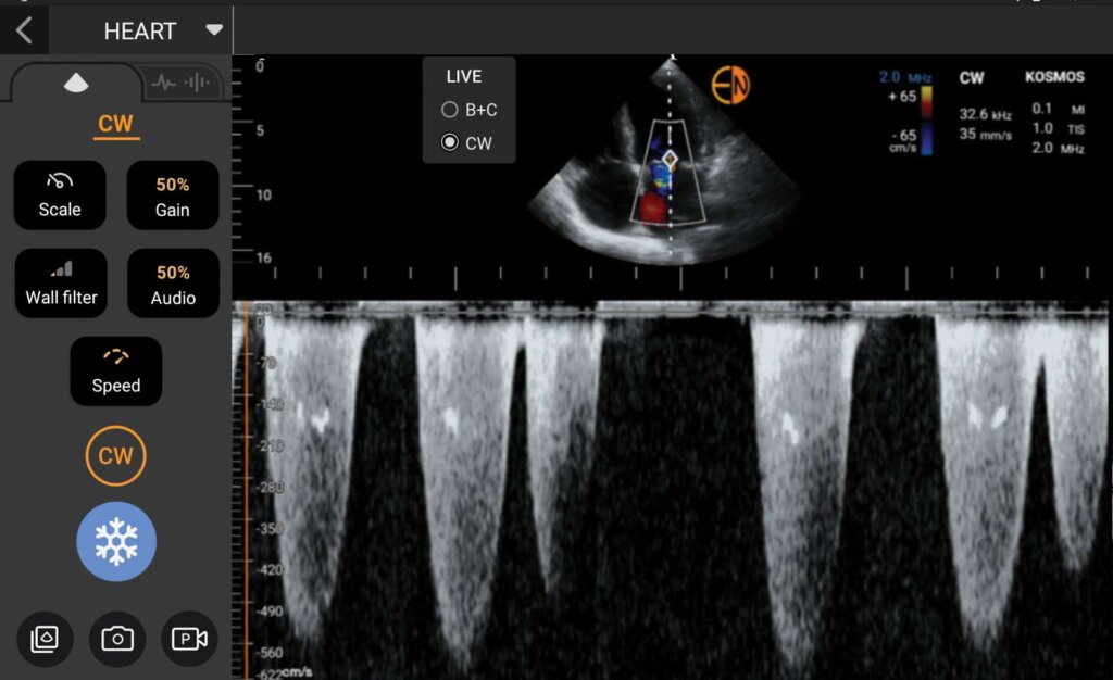 Kosmos CW Doppler