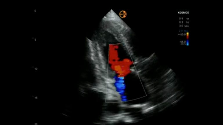 Amyloidosis Diagnosis With POCUS AI