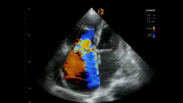 Finding Criteria for Myocardial Rupture With POCUS AI