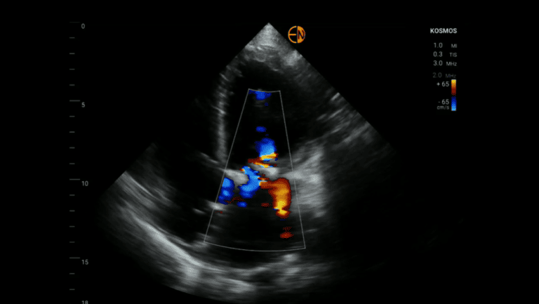 Identifying & Diagnosing Ischemic Mitral Regurgitation