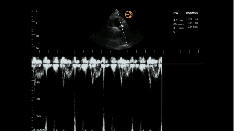 Identifying & Diagnosing a Pulmonary Embolism