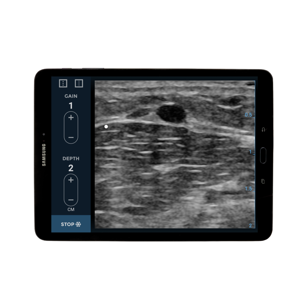 EchoNous Vein- EchoNous Ultrasound guidance designed for peripheral IV placement