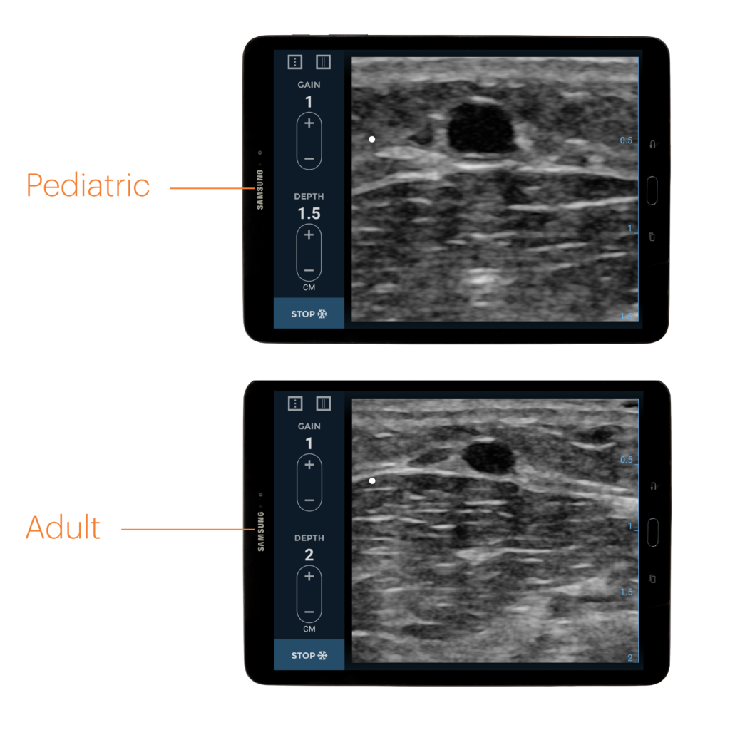 EchoNous Vein- Ultrasound guidance designed for peripheral IV placement