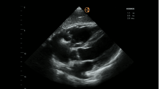 Finding Criteria for Arrhythmogenic Right Ventricular Cardiomyopathy (ARVC) with Ultrasound