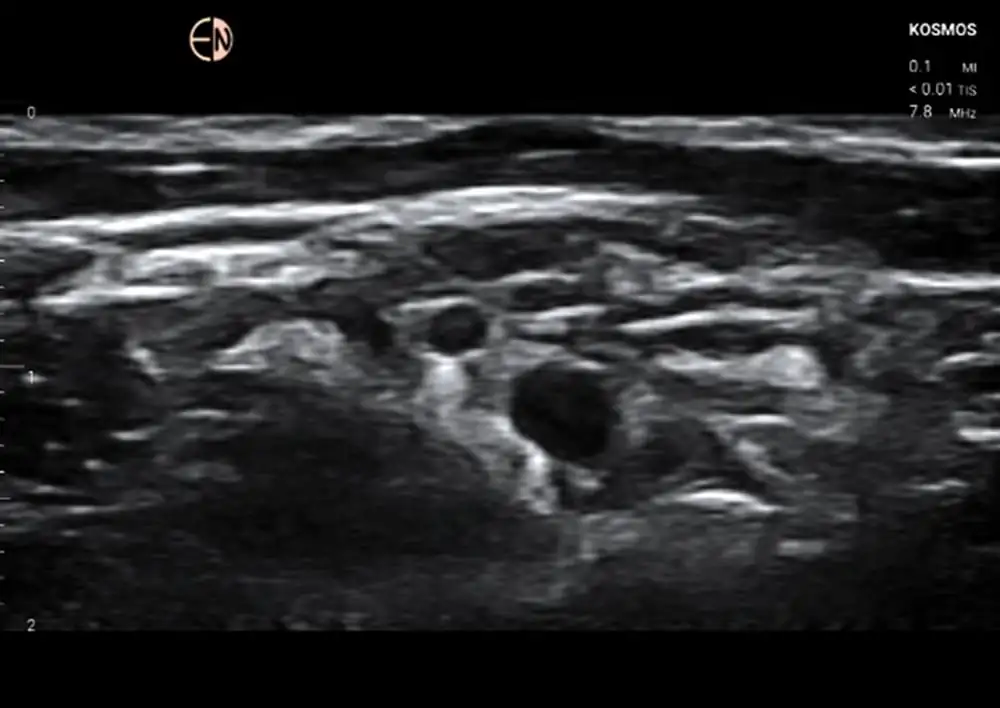 Image of Brachial Plexus