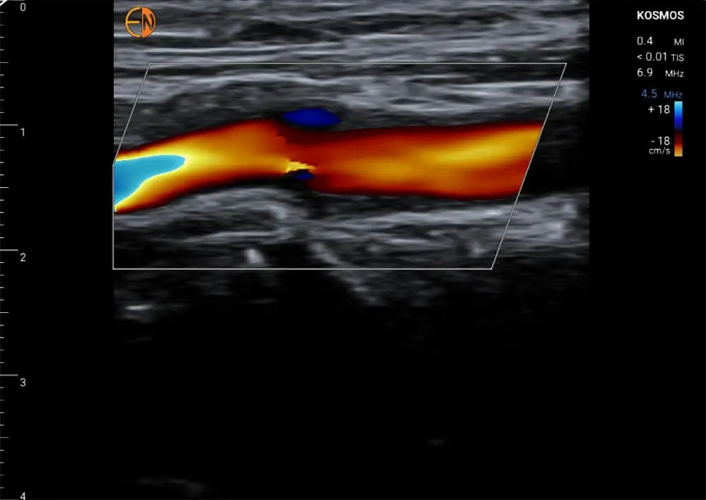 Image of Color Vascular on Lexsa