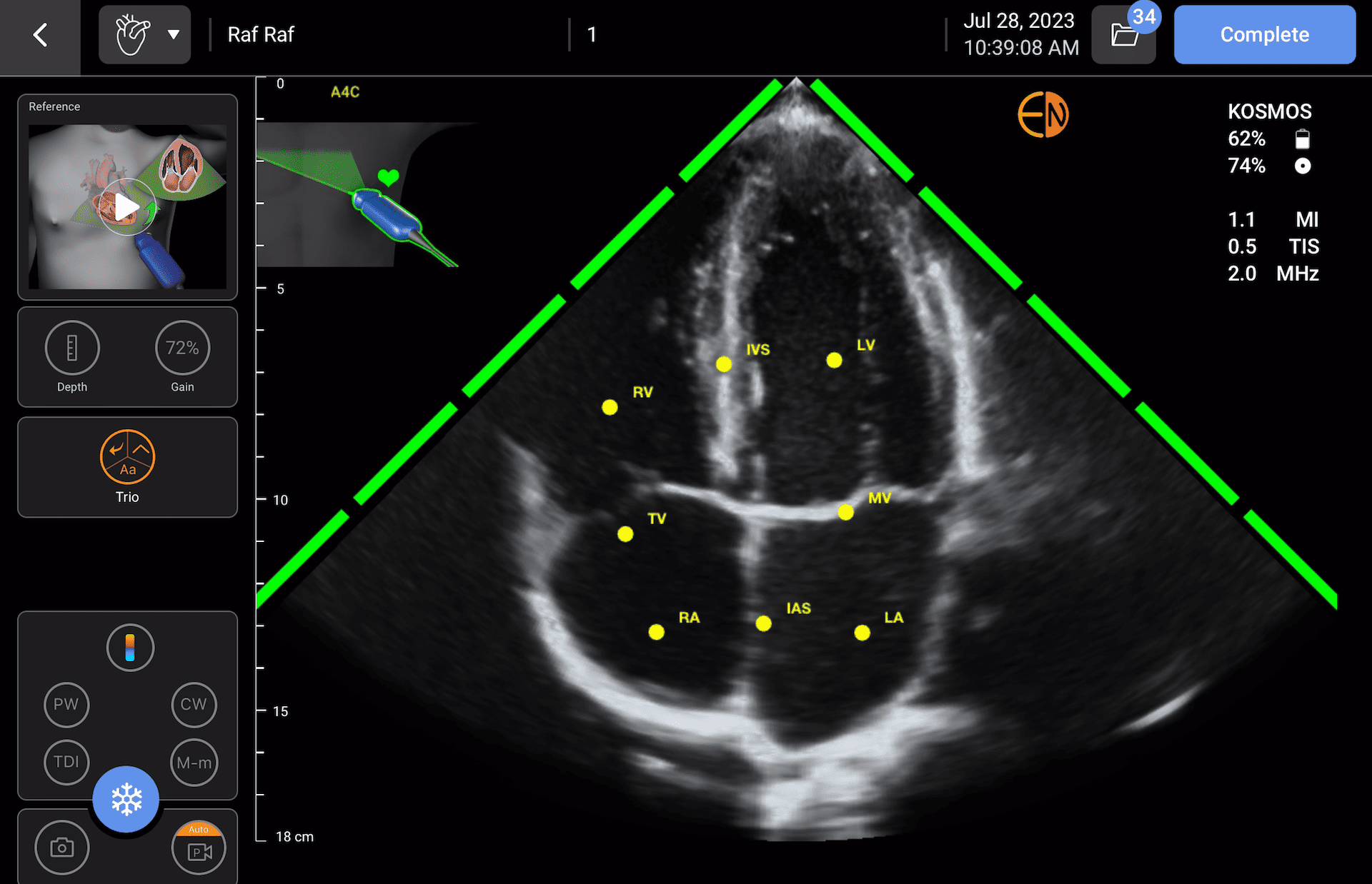 AI Handheld POCUS- automated guidance, grading, and labeling of cardiac anatomy