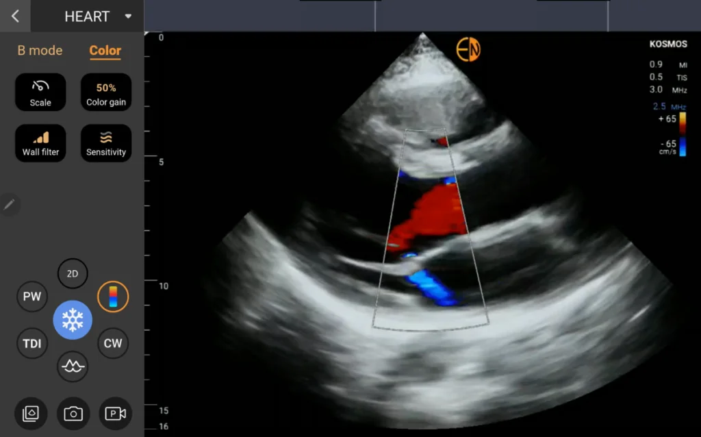 Color Doppler
