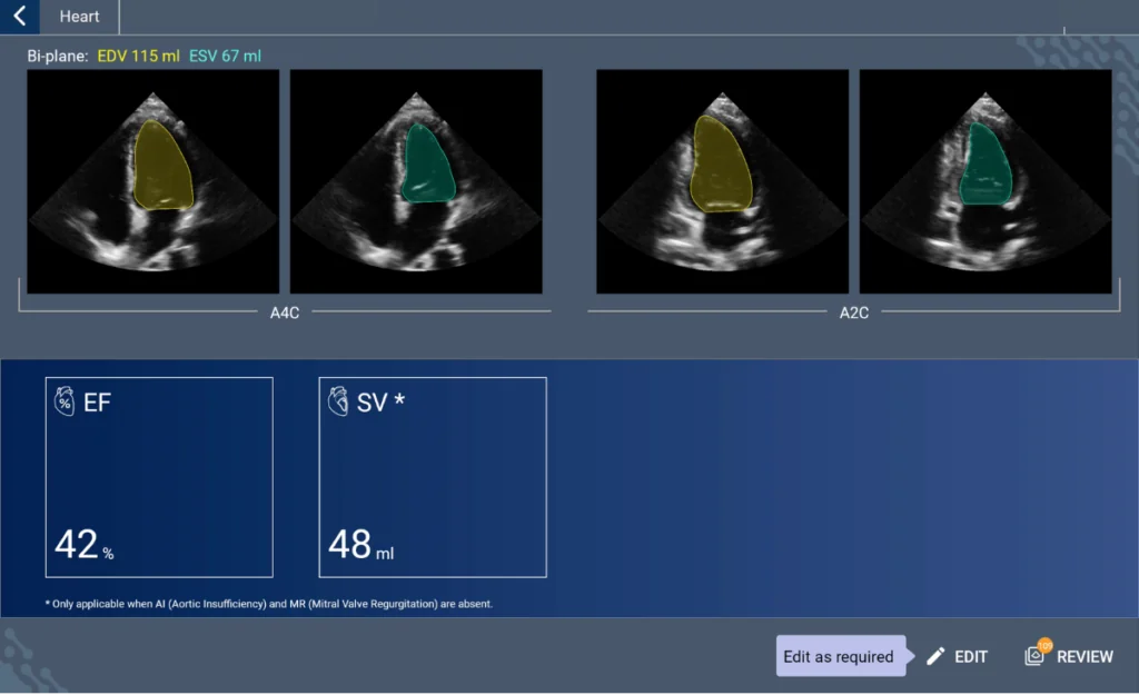Kosmos AI-assisted EF workflow: Systolic cardiac function calculations in seconds