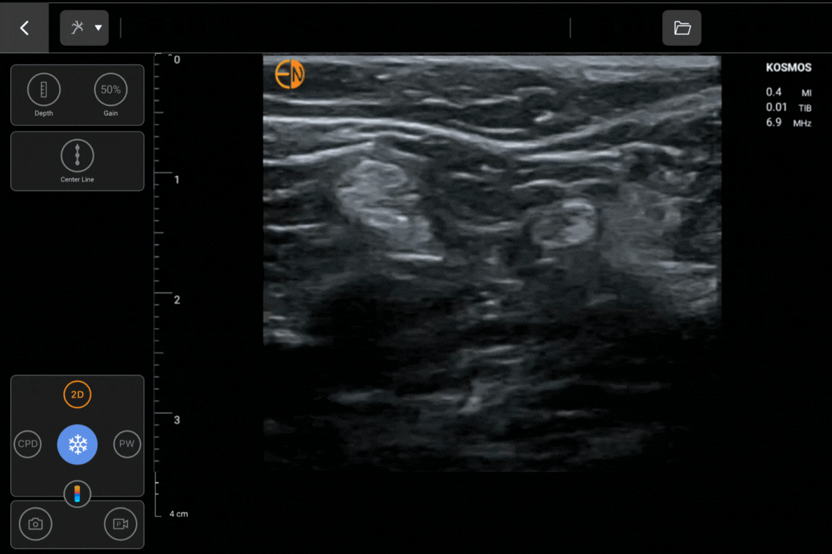 Popliteal Nerve on Kosmos POCUS ultrasound device with Lexsa probe