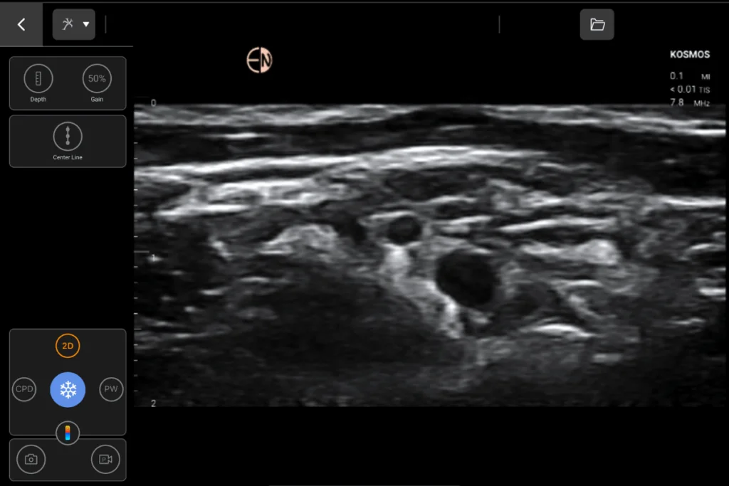 Supraclavicular Brachial Plexus using Kosmos Lexsa probe on Kosmos for Apple iOS