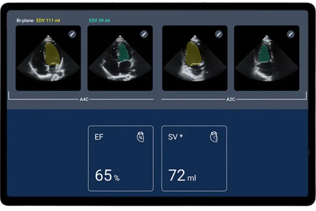 Kosmos AI-assisted Ejection Fraction Workflow