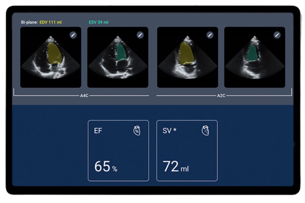 Kosmos Auto Ejection Fraction with Torso-One on Apple iOS and Android