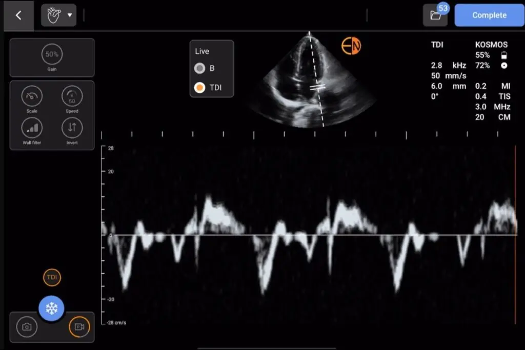 Kosmos TDI on Apple iOS. TDI allows for complete assessment of diastolic function