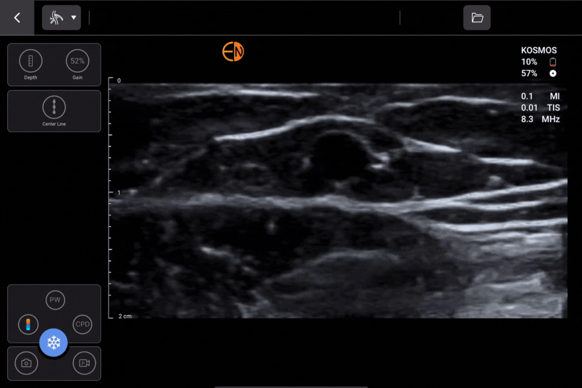 Cephalic Vein Transverse on Kosmos for Apple iOS and Android