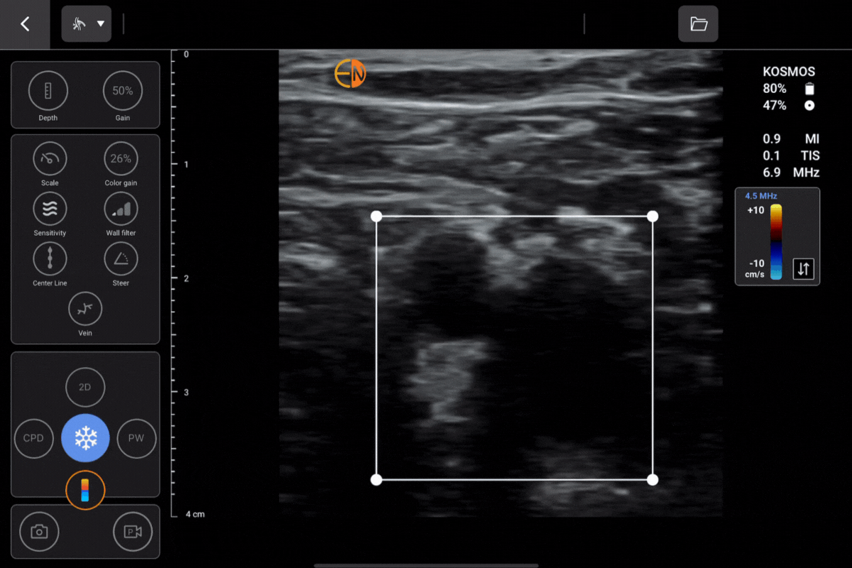 Femoral Vein and Artery using portable Kosmos Lexsa for Apple iOS and Android