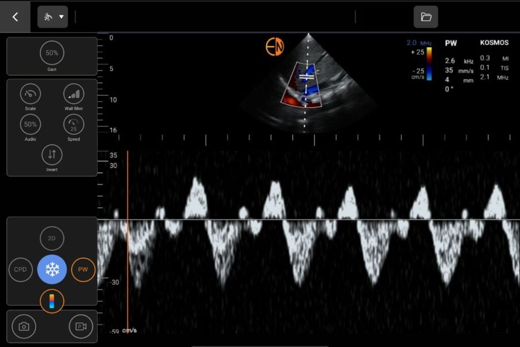 Kosmos Vascular Pulsed Wave and Color Doppler on Apple iOS and Android