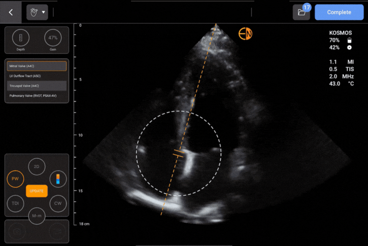 Auto Doppler automatically places the sample gate in the optimal location for the cardiac valve of interest, drastically simplifying valve interrogation for POCUS users.