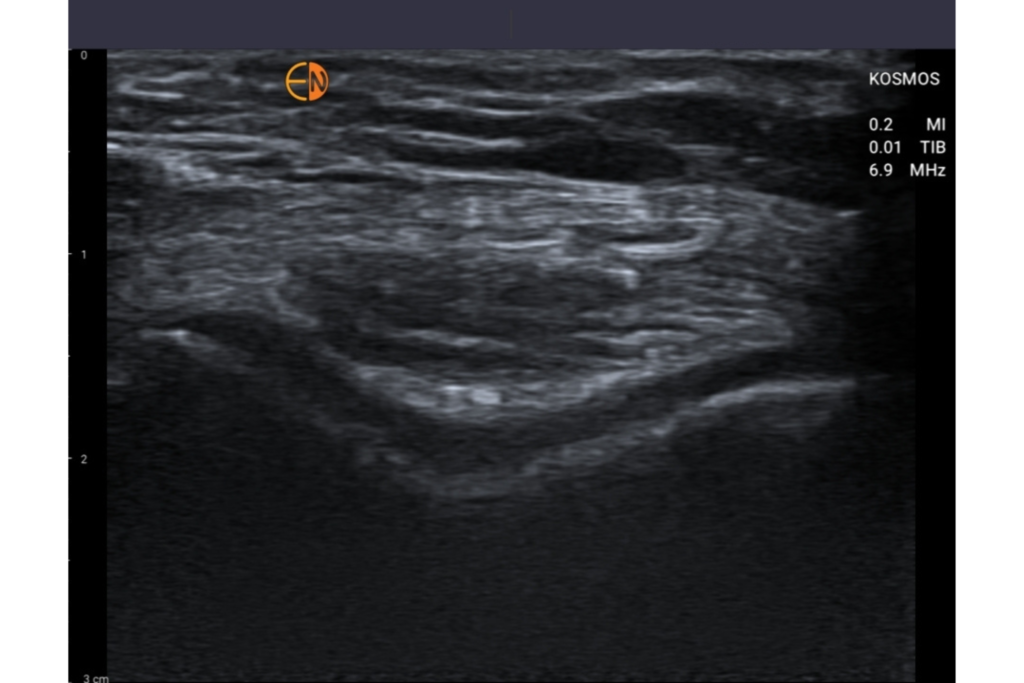 Musculoskeletal (MSK) Ultrasound, Articular Cartilage of the Trochlea