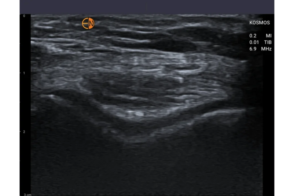 Musculoskeletal (MSK) Ultrasound, Articular Cartilage of the Trochlea