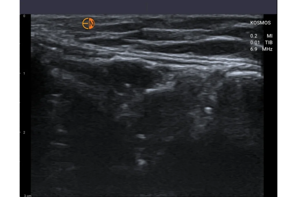 Musculoskeletal (MSK) Ultrasound- Medial Collateral Ligament and Pathology