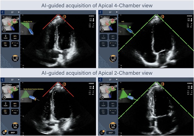 Kosmos Artificial intelligence-assisted acquisition of optimal apical four-chamber and two-chamber echocardiographic
