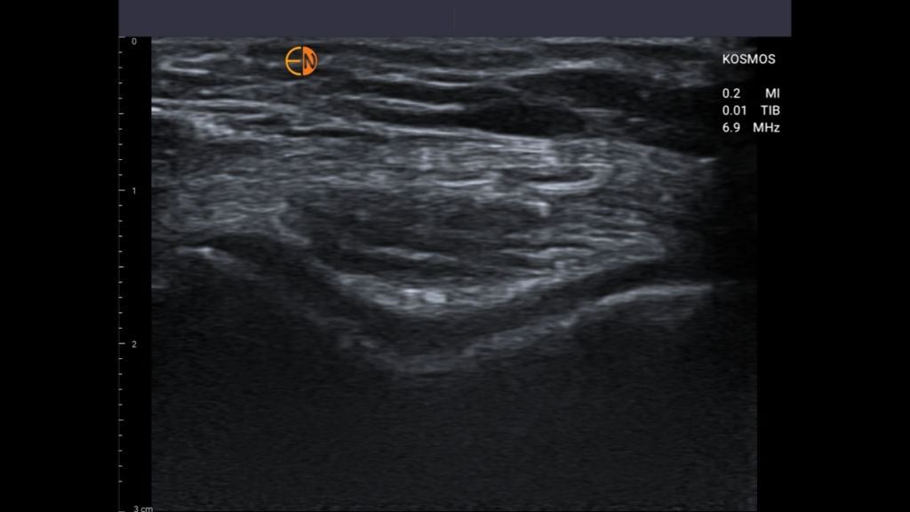 Articular cartilage of the trochlea