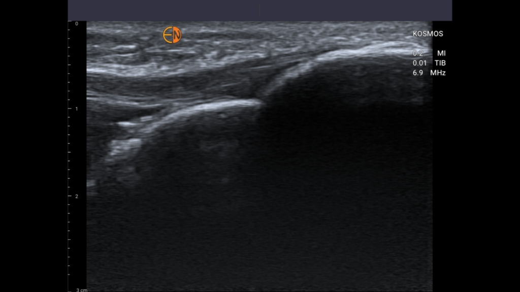 Tibial Insertion of Patella tendon