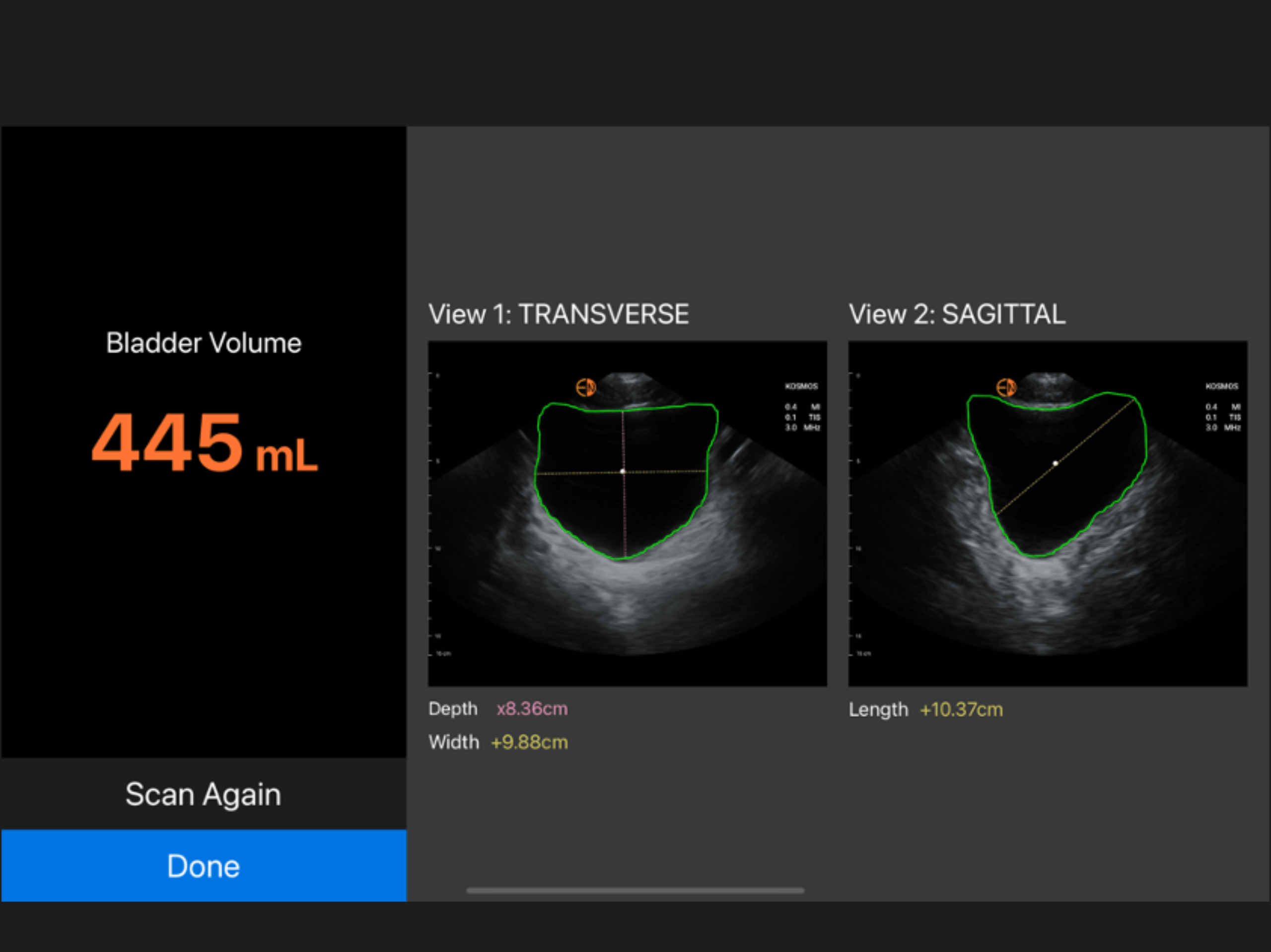 Bladder Volume Results Screen