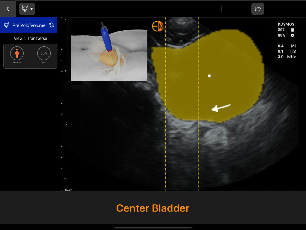 Kosmos Bladder Transverse View with AI Instructions to center probe