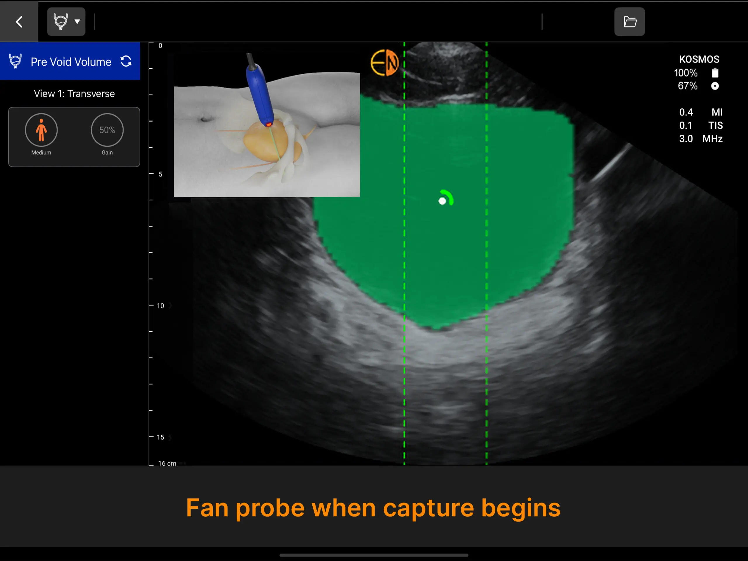 Kosmos Bladder Transverse View