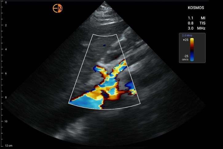 Kosmos Color Power Doppler