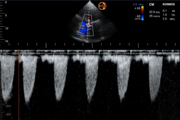 Kosmos CW Doppler