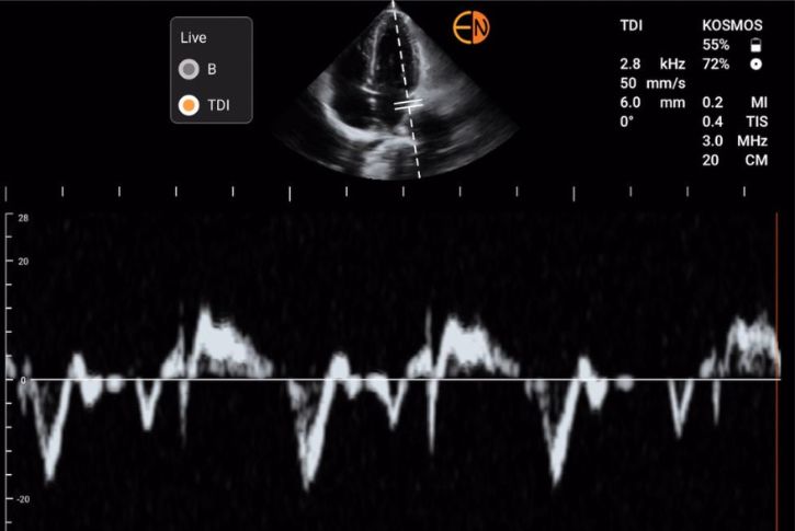 Kosmos Tissue Doppler Imaging