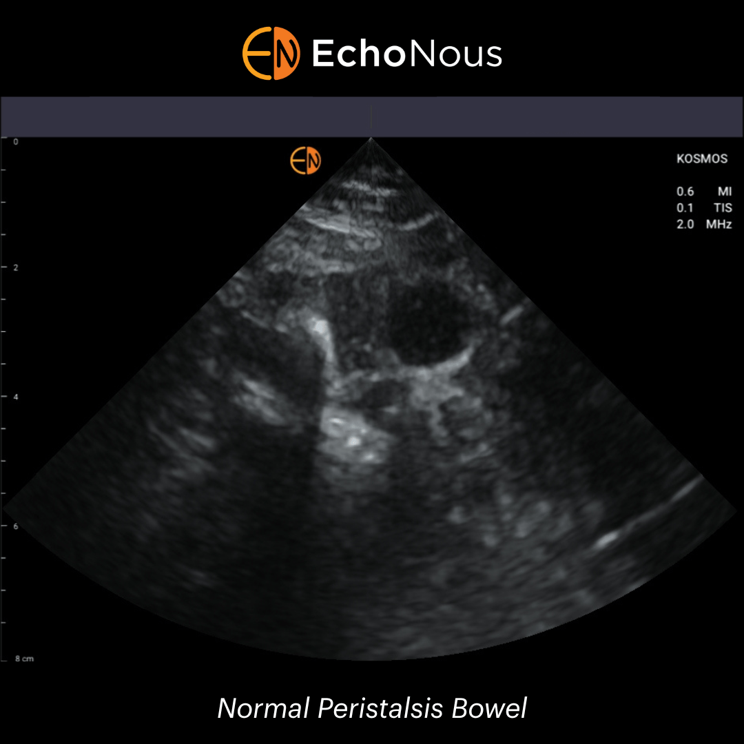 Bowel Ultrasound for Family Physicians