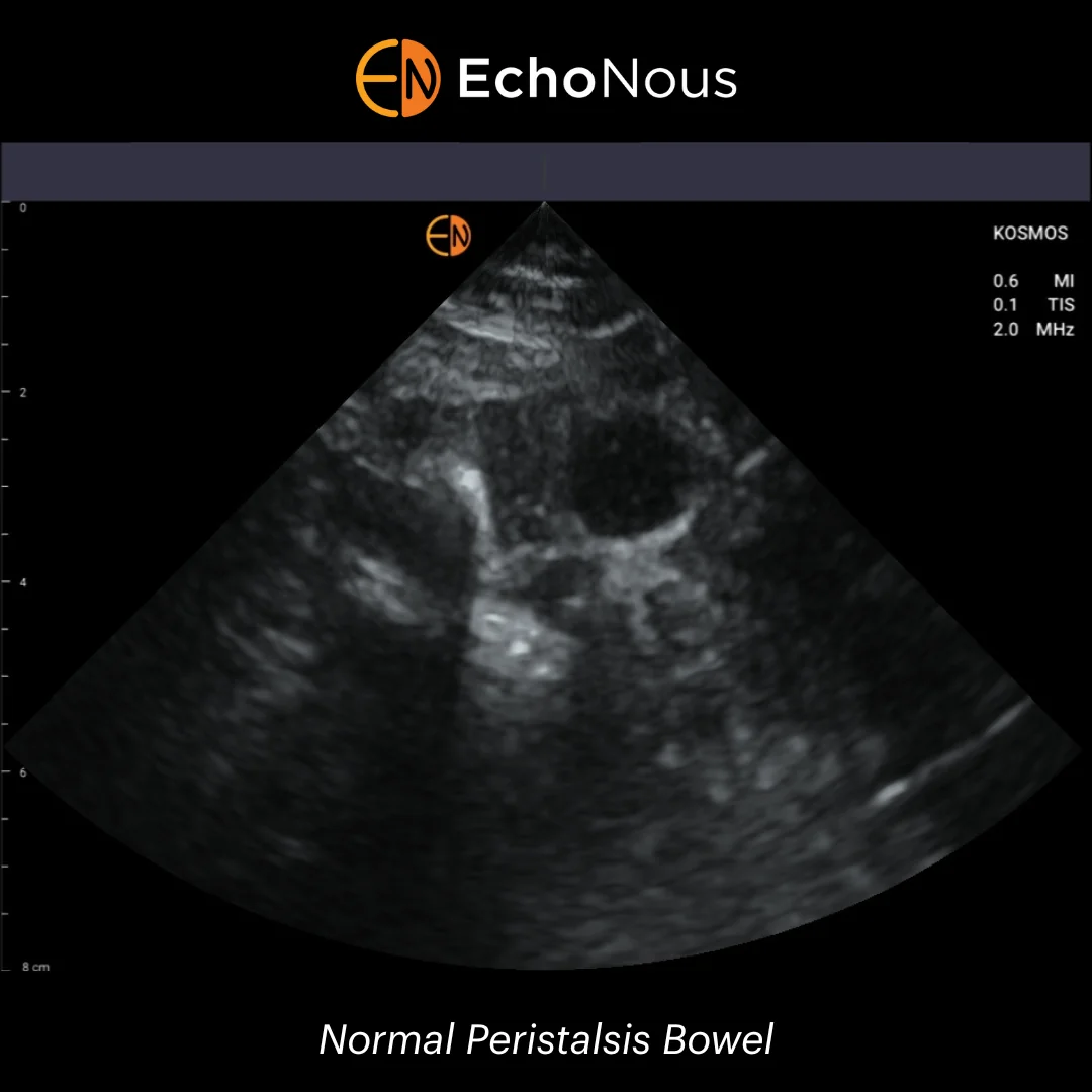 Bowel Ultrasound for Family Physicians