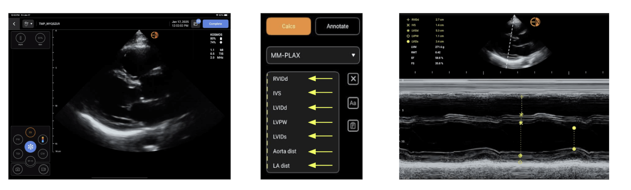 3 Ways to Measure LVEF on Kosmos | EchoNous