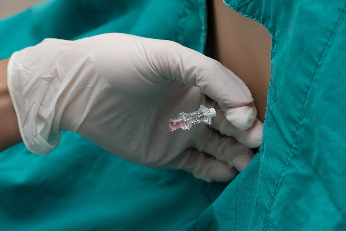 From Palpation to Visualization: Why POCUS is Redefining the Lumbar Puncture